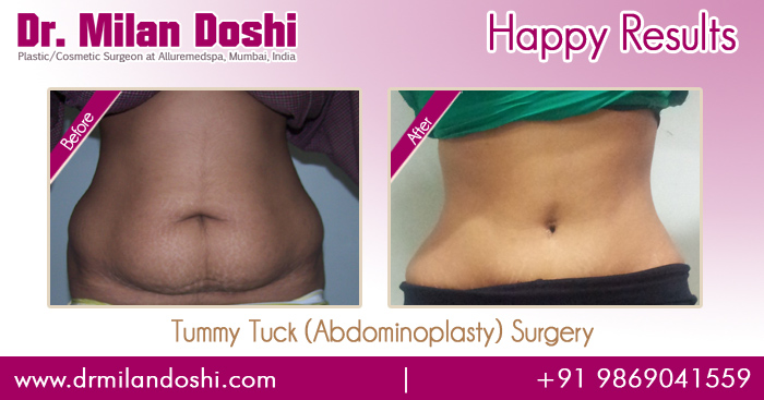 Tummy Tuck Surgery Before and After Photos